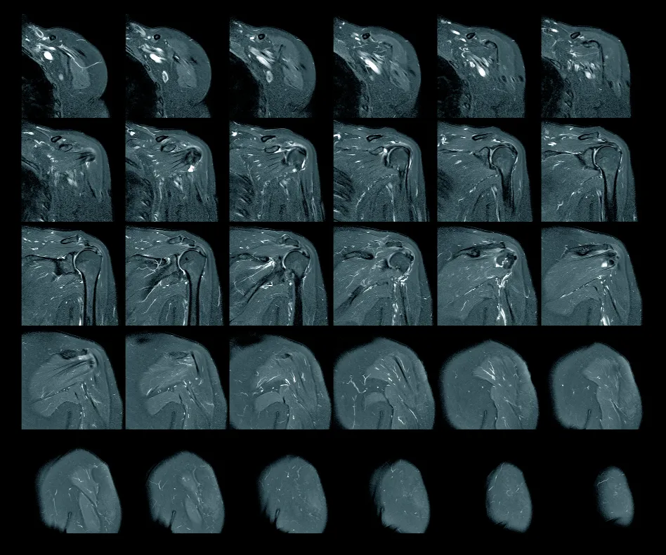 Shoulder MRI Image
